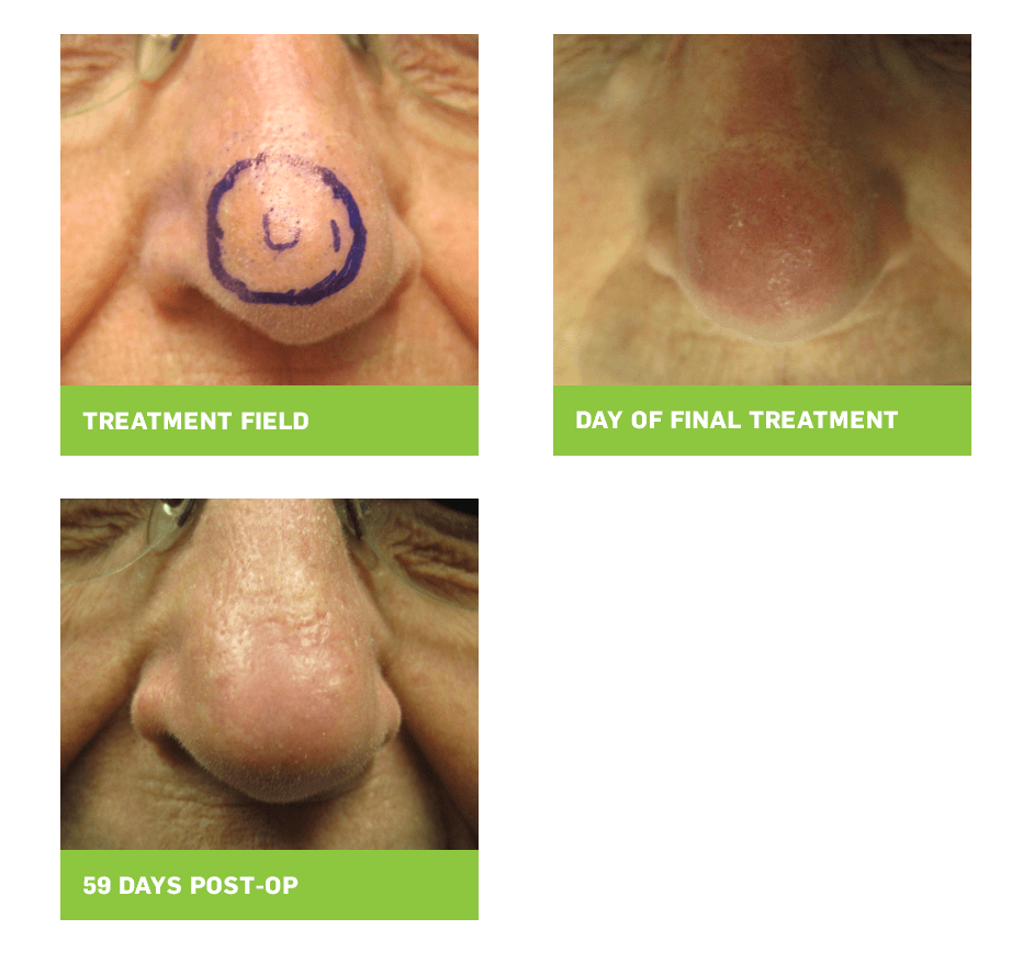 Sensus Healthcare clinical photo of BCC on nose