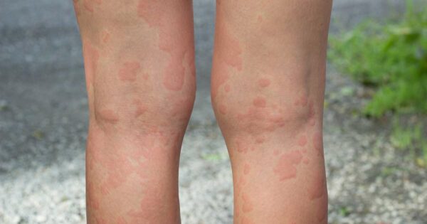 Skin allergy with hives on back of woman's legs